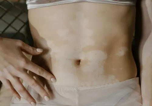 Día Mundial del Vitiligo: qué es, a quiénes afecta y cuál es su tratamiento