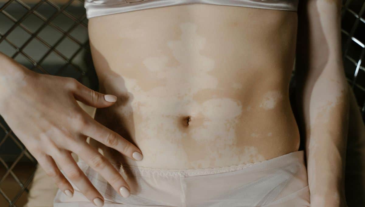 Día Mundial del Vitiligo: qué es, a quiénes afecta y cuál es su tratamiento