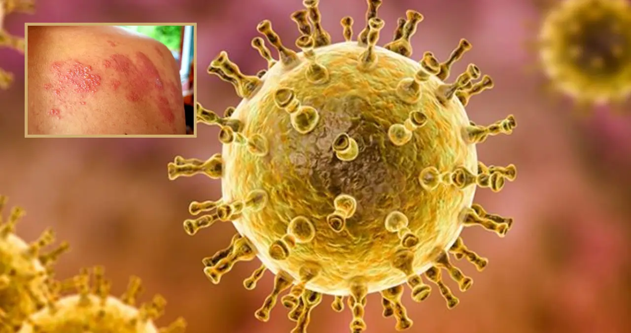 Herpes Zóster “Culebrilla”: ¿Qué personas pueden desarrollar esta dolorosa afección?