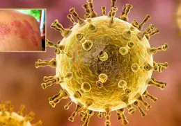 Herpes Zóster “Culebrilla”: ¿Qué personas pueden desarrollar esta dolorosa afección?