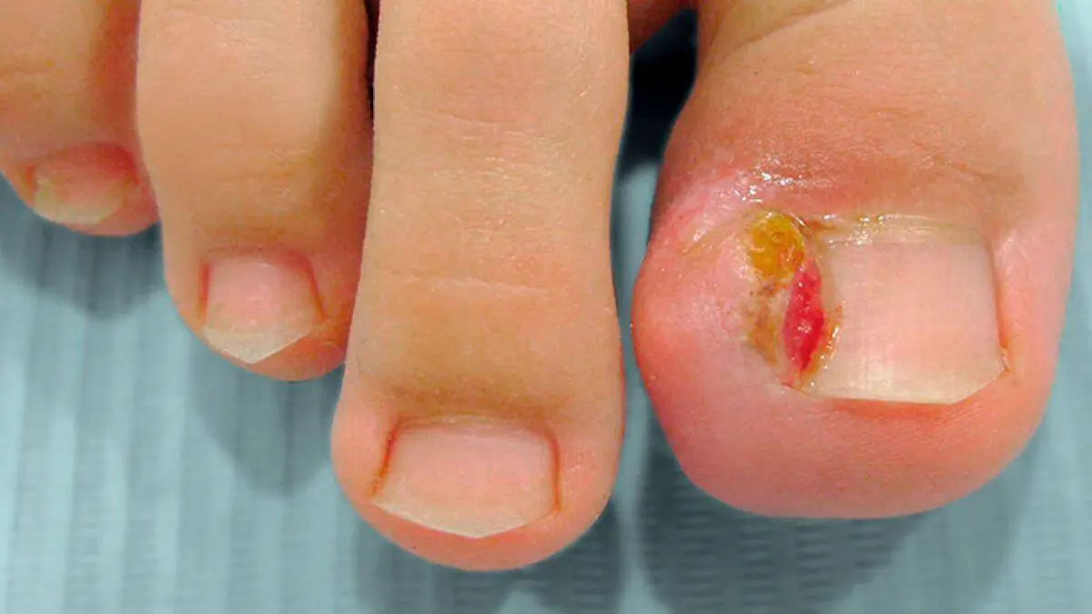 ¿Se te entierran las uñas de los pies constantemente? Así puedes prevenir este problema