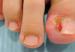 ¿Se te entierran las uñas de los pies constantemente? Así puedes prevenir este problema