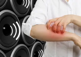 Día Mundial de la Alergia: 5 alergias poco frecuentes e insólitas que quizás no sabías que existían