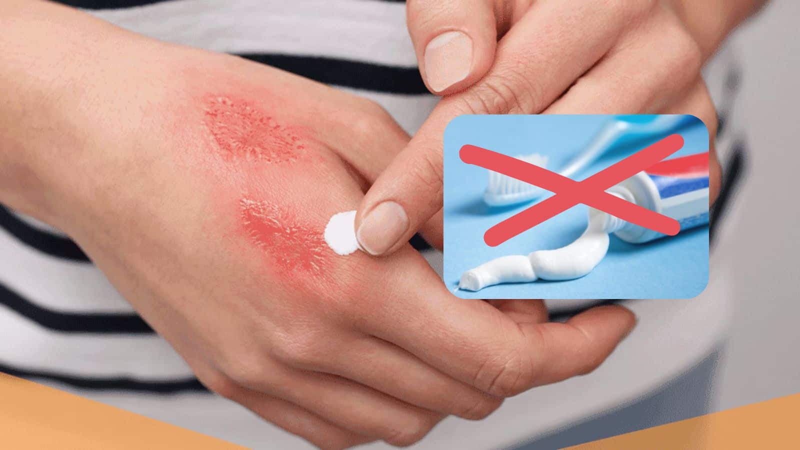 ¿Por qué NO debes aplicar pasta dental en quemaduras? Esto revelan los expertos