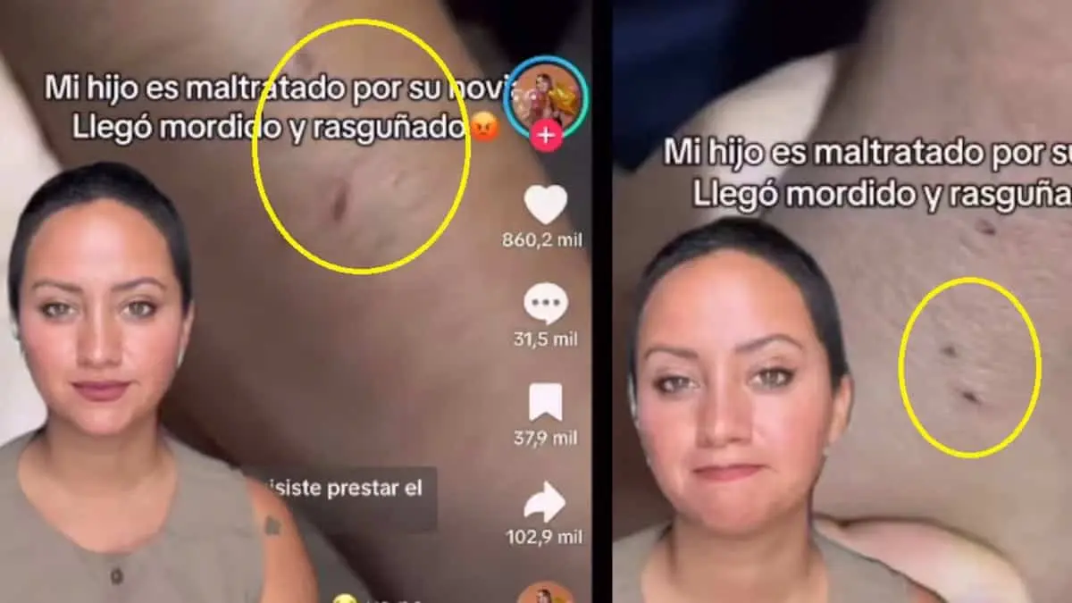 VIDEO | Influencer muestra la indignación de una madre por las heridas de su hijo. Acusa a la novia de lesiones