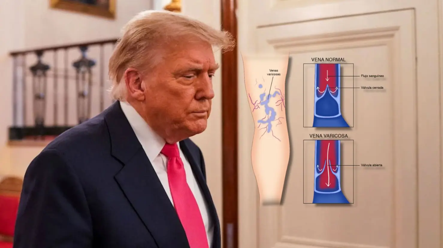 Insuficiencia venosa crónica: ¿Qué es y cómo afecta esta enfermedad que padece el presidente Trump?