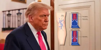Insuficiencia venosa crónica: ¿Qué es y cómo afecta esta enfermedad que padece el presidente Trump?