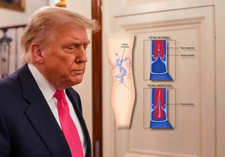 Insuficiencia venosa crónica: ¿Qué es y cómo afecta esta enfermedad que padece el presidente Trump?