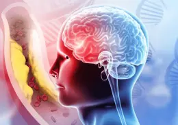 Infartos cerebrales en jóvenes van en aumento en México: conoce las causas