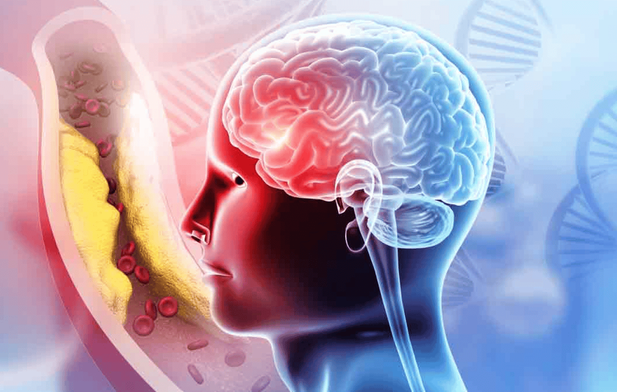 Infartos cerebrales en jóvenes van en aumento en México: conoce las causas