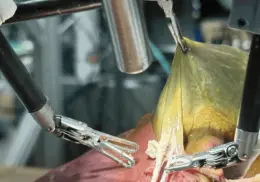 Robot con IA realiza cirugía de vesícula biliar sin asistencia humana por primera vez