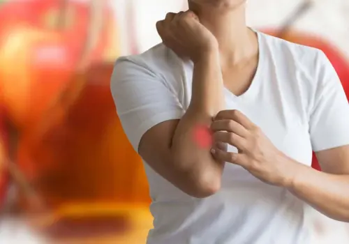 ¿Tienes comezón en una roncha? 3 remedios naturales que ayudan a sobrellevarlo