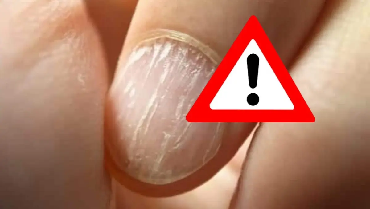Estrías en las uñas; riesgos que implican para la salud. Foto: Original