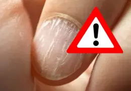Estrías en las uñas; riesgos que implican para la salud
