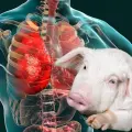 China realiza el primer trasplante de pulmón de cerdo a un humano