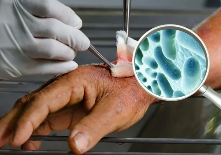 ¿Cómo puedo protegerme de la bacteria come carne ante el repunte de casos en costas de EU?