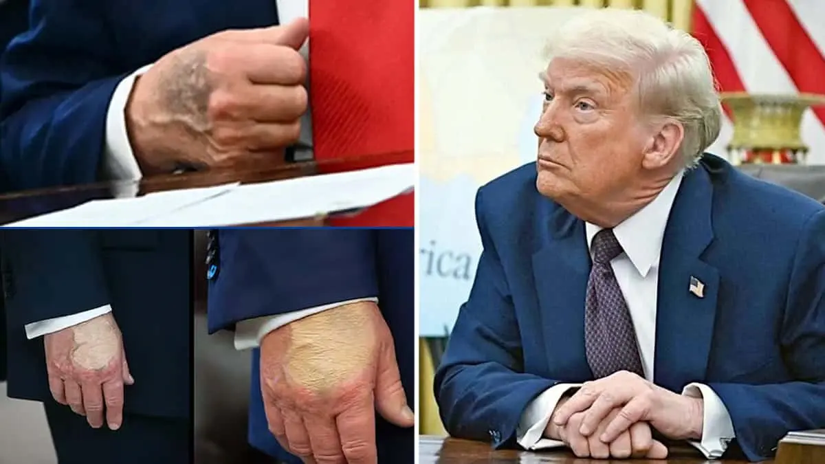 Trump muestra las mismas lesiones que la reina Isabel antes de morir; el mandatario rompe el silencio tras rumores