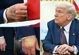 Trump muestra las mismas lesiones que la reina Isabel antes de morir; el mandatario rompe el silencio tras rumores