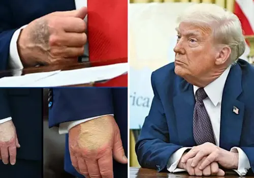 Trump muestra las mismas lesiones que la reina Isabel antes de morir; el mandatario rompe el silencio tras rumores