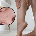 ¿Ya te empezaron a salir varices? Esto es lo que puedes hacer