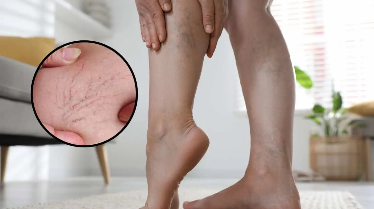 Detectarlas a tiempo es clave para evitar complicaciones como tromboflebitis o úlceras venosas