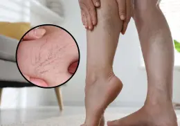 ¿Ya te empezaron a salir varices? Esto es lo que puedes hacer
