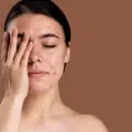 5 errores comunes que aumentan el acné y dañan tu piel