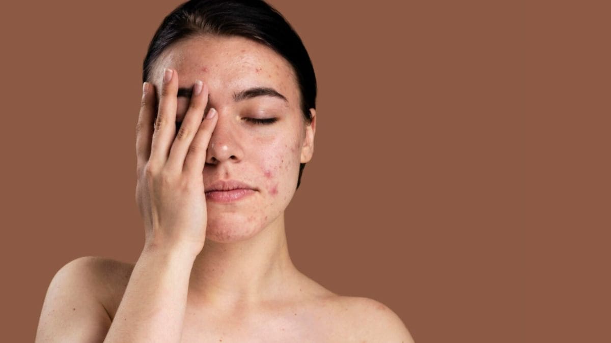 5 errores comunes que aumentan el acné y dañan tu piel