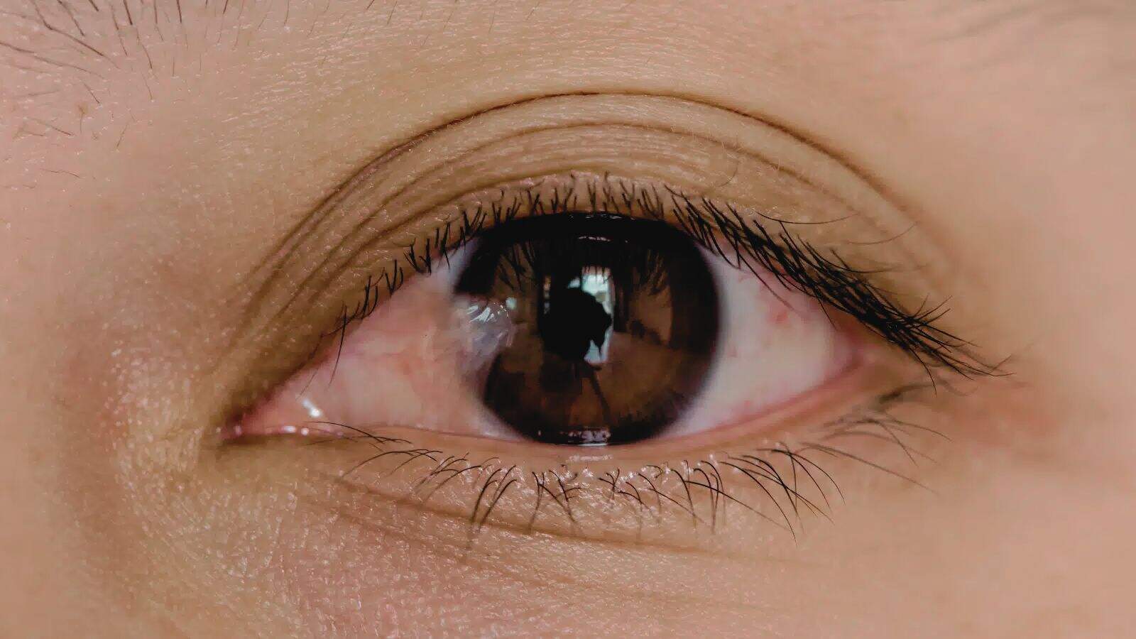 ¿Qué es la carnosidad en los ojos y cómo lo podrías prevenir?