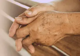 ¿Son por la edad? Esto significan las manchas cafés en las manos