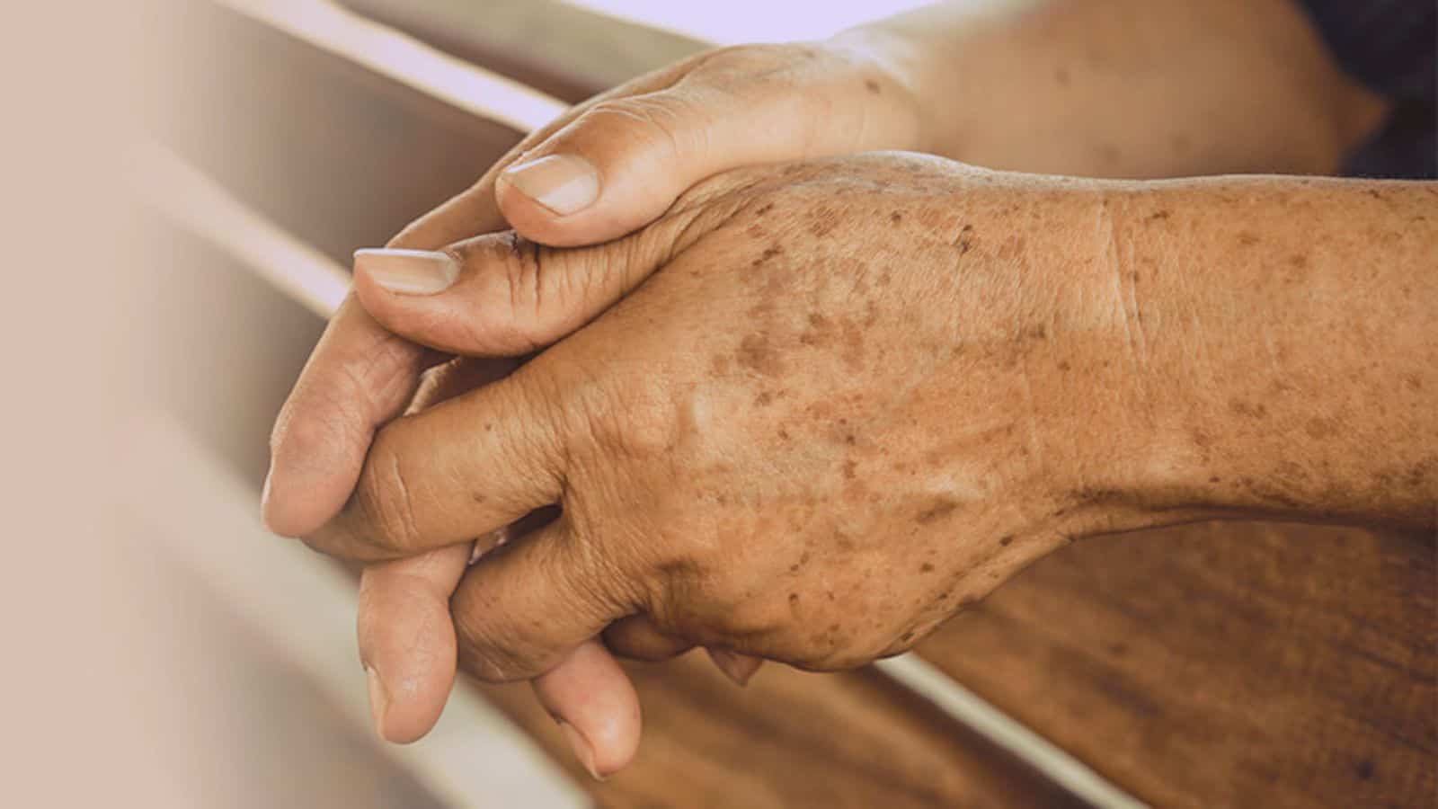 ¿Son por la edad? Esto significan las manchas cafés en las manos