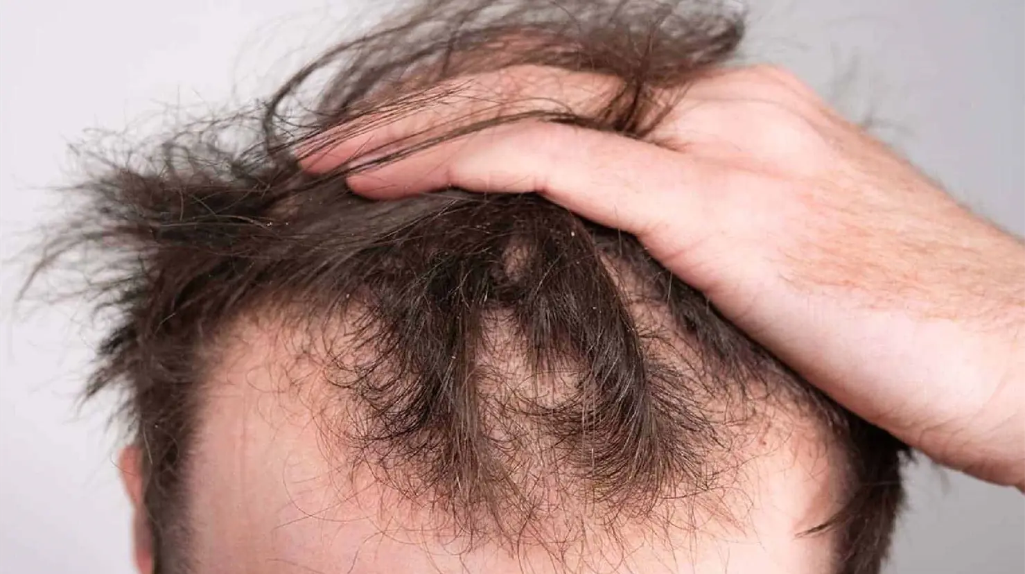 ¿Se te cae el cabello? Identifica y elimina los hábitos que aceleran la calvicie