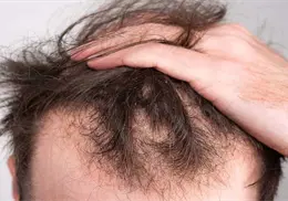 ¿Se te cae el cabello? Identifica y elimina los hábitos que aceleran la calvicie