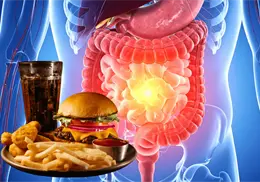 Estudio vincula consumo de alimentos ultraprocesados con aumento de cáncer de colon en jóvenes