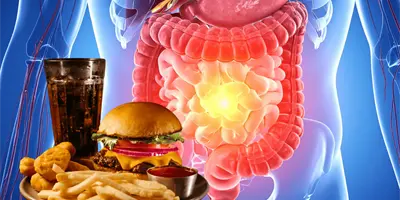 Estudio vincula consumo de alimentos ultraprocesados con aumento de cáncer de colon en jóvenes Estudio vincula consumo de alimentos ultraprocesados con aumento de cáncer de colon en jóvenes