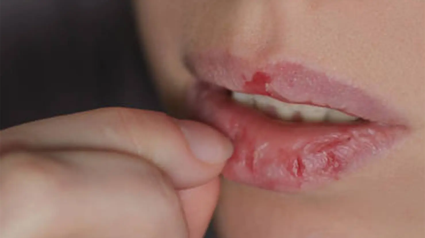 ¿Es malo quitarse los cueritos de los labios? Expertos explican por qué evitarlo