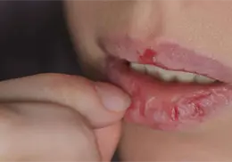 ¿Es malo quitarse los cueritos de los labios? Expertos explican por qué evitarlo ¿Es malo quitarse los cueritos de los labios? Expertos explican por qué evitarlo