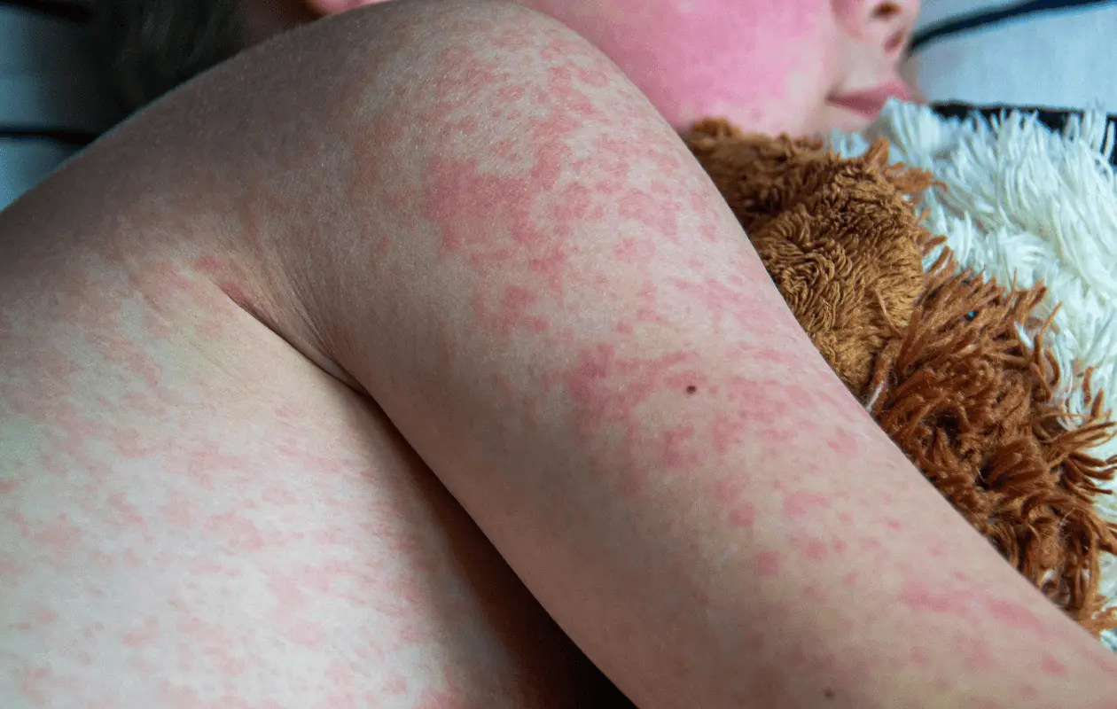 Los casos confirmados de sarampi&oacute;n se distribuyen en 29 estados del pa&iacute;s.