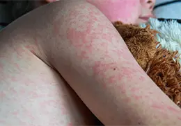 Sarampi&oacute;n en M&eacute;xico: 24 muertes y casi 6 mil casos confirmados