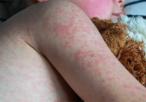 Sarampi&oacute;n en M&eacute;xico: 24 muertes y casi 6 mil casos confirmados