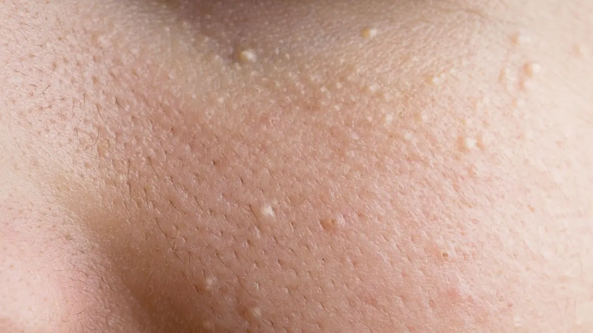 ¿Qué significan los puntos blancos que salen de la nada en la piel?