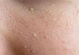 &iquest;Qu&eacute; significan los puntos blancos que salen de la nada en la piel?