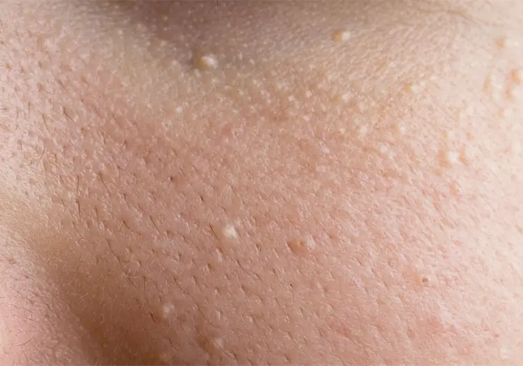 &iquest;Qu&eacute; significan los puntos blancos que salen de la nada en la piel?