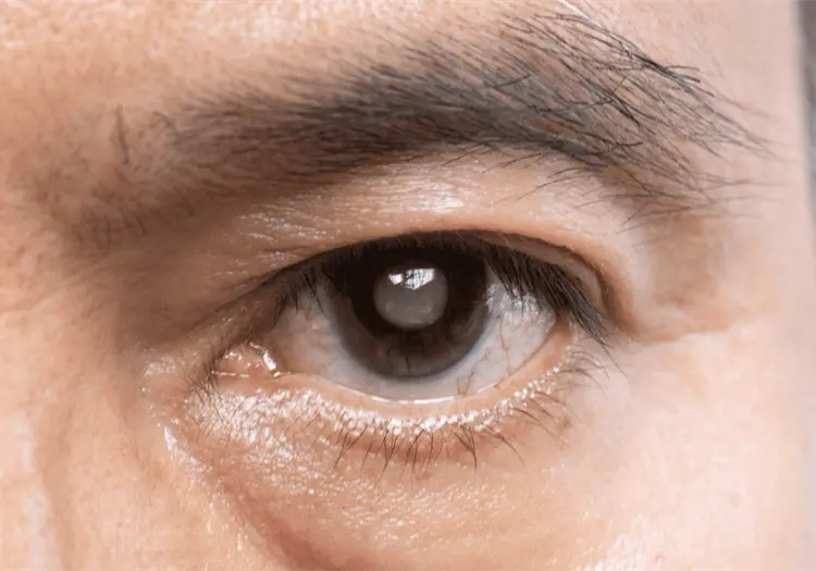 Aumentan cataratas oculares por diabetes: as&iacute; se pueden prevenir