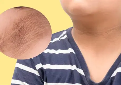 &iquest;Qu&eacute; es la acantosis pigmentaria y qu&eacute; revela sobre tu salud cuando aparece?