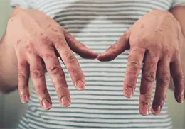 Ante aumento de casos de sarampi&oacute;n, UNAM recomienda vacunarse