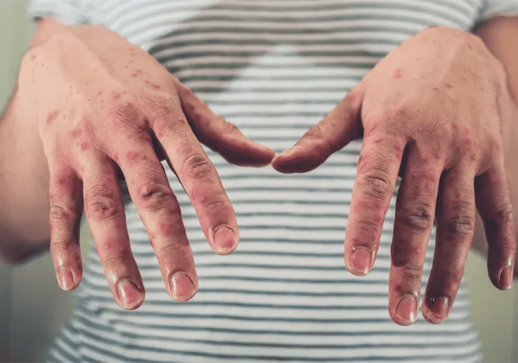 Ante aumento de casos de sarampi&oacute;n, UNAM recomienda vacunarse