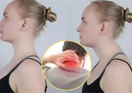 Conoce cómo eliminar la joroba de búfalo y evitar que vuelva a aparecer Conoce cómo eliminar la joroba de búfalo y evitar que vuelva a aparecer