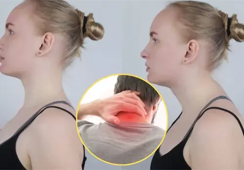 Conoce c&oacute;mo eliminar la joroba de b&uacute;falo y evitar que vuelva a aparecer