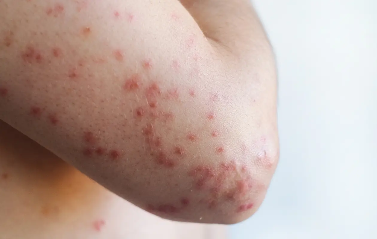 El grupo de edad m&aacute;s afectado es el de 1 a 4 a&ntilde;os.